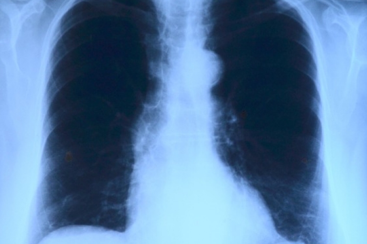 Elvégezték az országban az első tüdőverőér-tágítást
