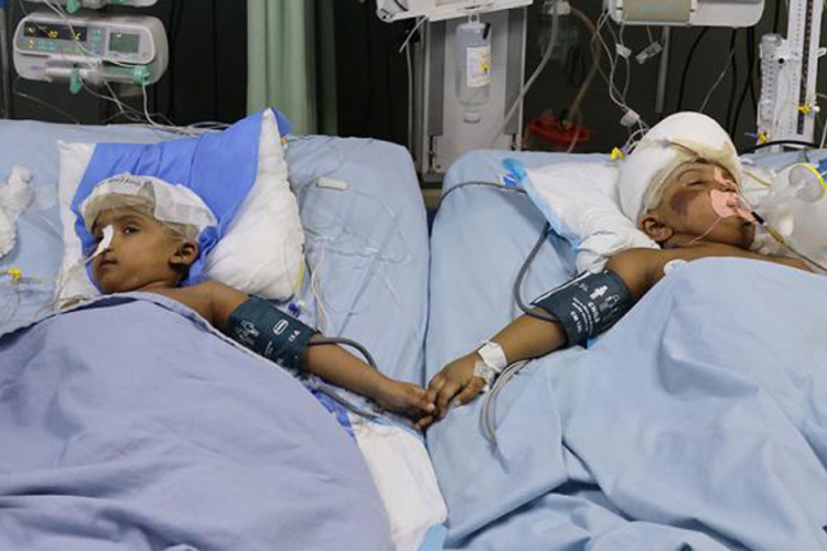 Szétválasztott sziámi ikrek - Rabeyán sürgős műtétet kellett végezni